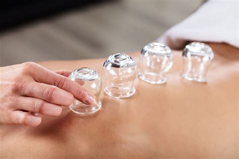 Cupping Massage Therapies In Derby